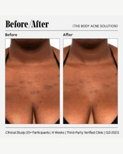 The Body Acne Solution -WELA Beauty Shop Necessaire RetailerGraphics 2023 TheBodyAcneSolution 09