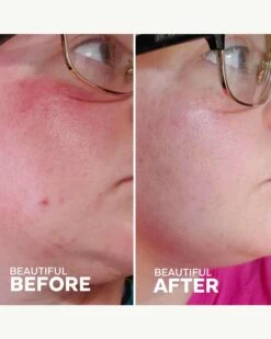 Radiance Grape Stem Cell + Squalane Day Cream 12 Radiance Grape Stem Cell + Squalane Day Cream -WELA Beauty Shop ThreeShips RadianceDayCream BeforeAfter 04